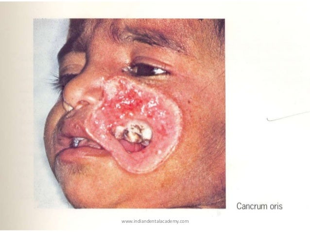 Clit lick closeup tube Facial rash from dental implant